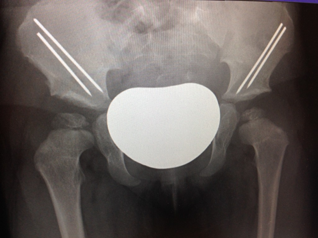 Caitlin, Hip Dysplasia